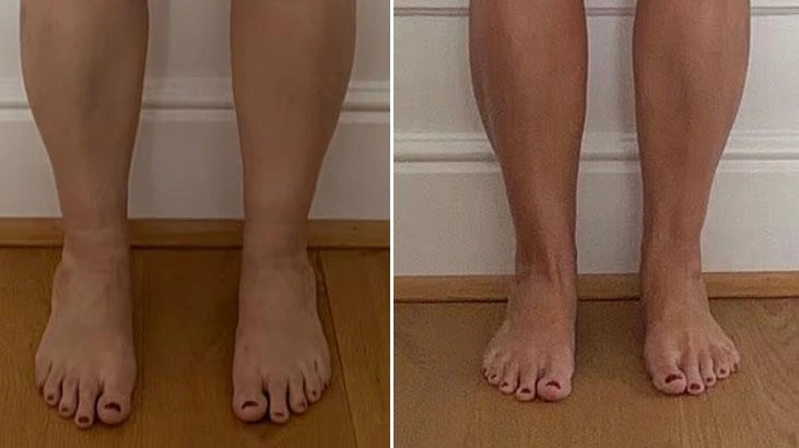 Pnömatik kompresyon pantolonu ayak bileği şişliğinde etkili oldu