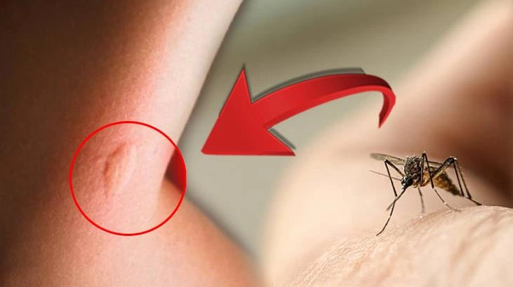 Sivrisinek ısırığı alerjisi nedir, nasıl anlaşılır?
